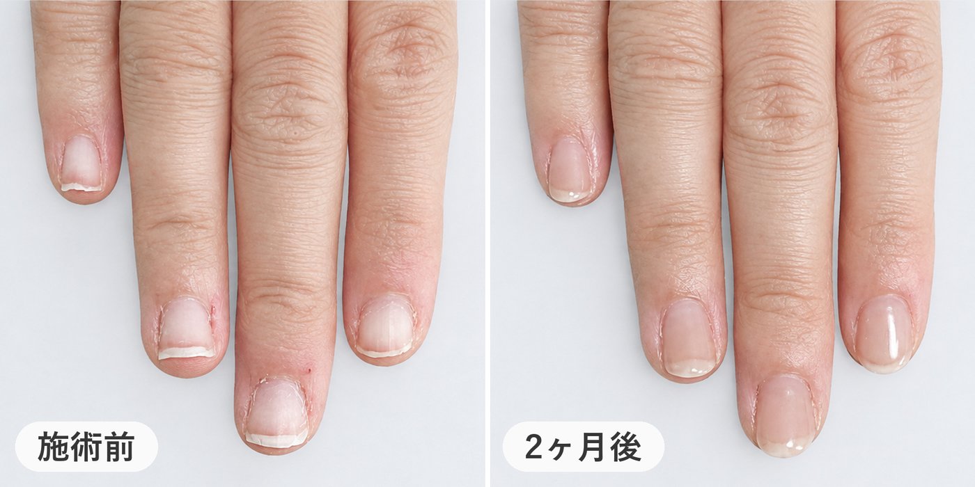 爪が小さくピンクの部分が短い方の左手。施術前と2ヶ月後の比較