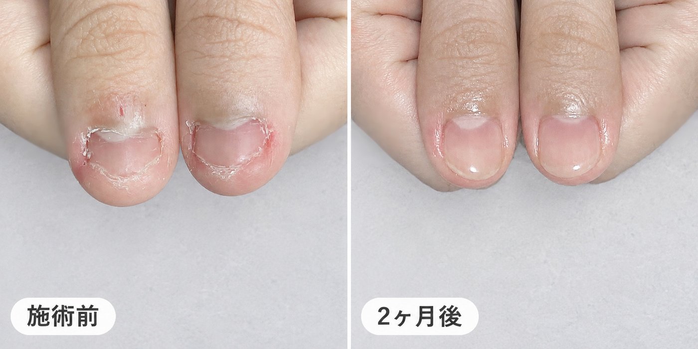 爪を噛む癖のある方の親指。施術前と2ヶ月後の比較