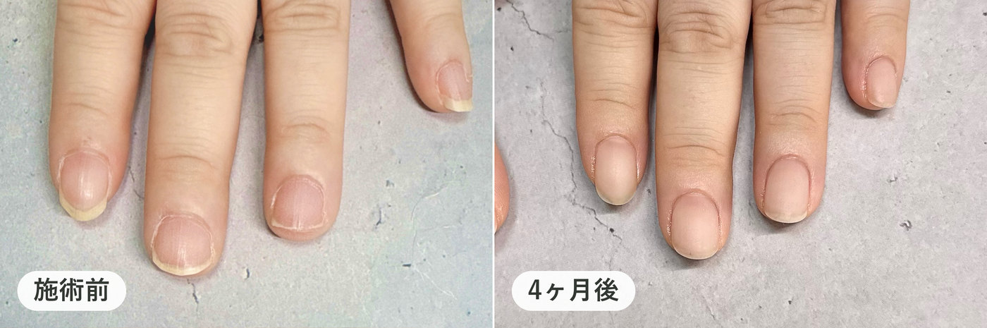 同じ方の左手の指4本。施術前と4ヶ月後の比較