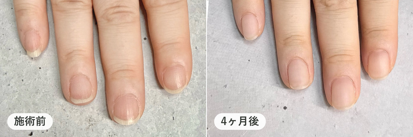 同じ方の右手の指4本。施術前と4ヶ月後の比較