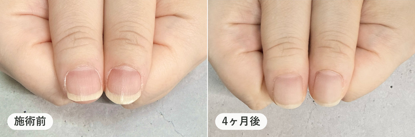 ピンクの部分が短い方の両手の親指。施術前と4ヶ月後の比較
