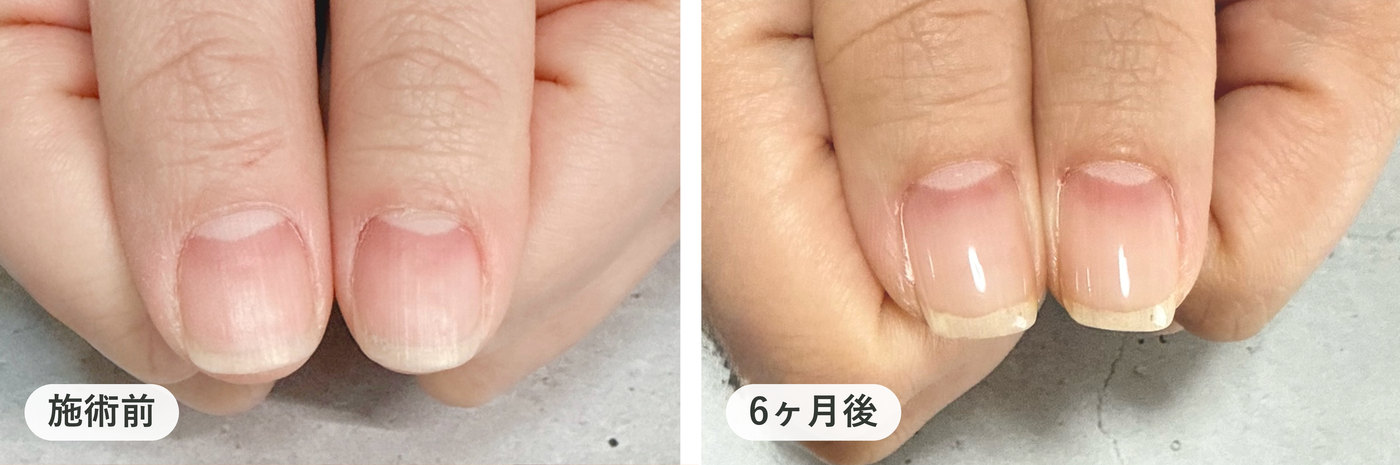 ピンクの部分を伸ばしたい方の両手の親指。施術前と6ヶ月後の比較
