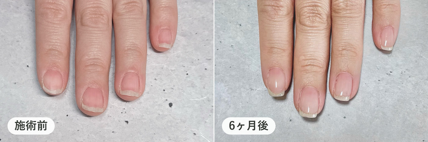 同じ方の左手の指4本。施術前と6ヶ月後の比較