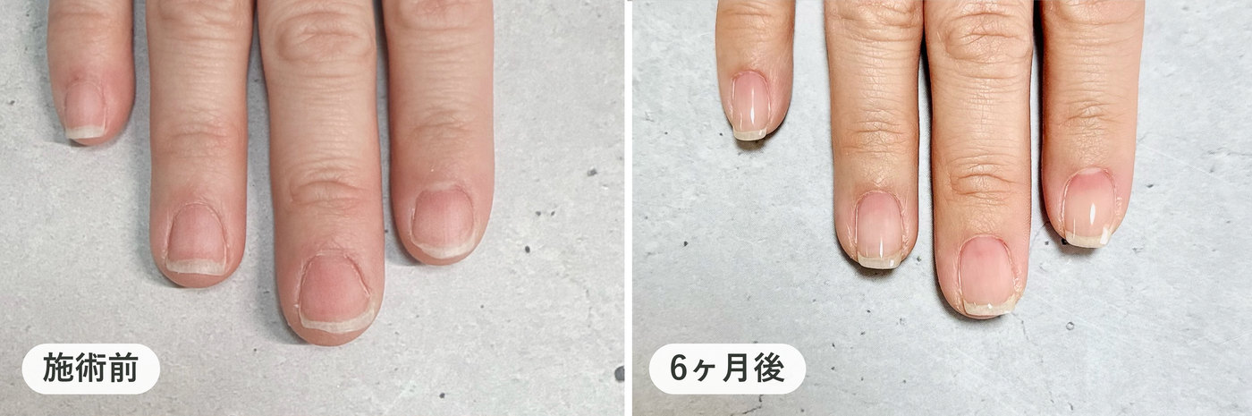 同じ方の右手の指4本。施術前と6ヶ月後の比較